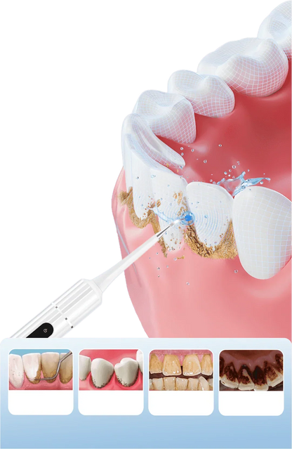 Ultrasonic Teeth Whitening Cleaner Set