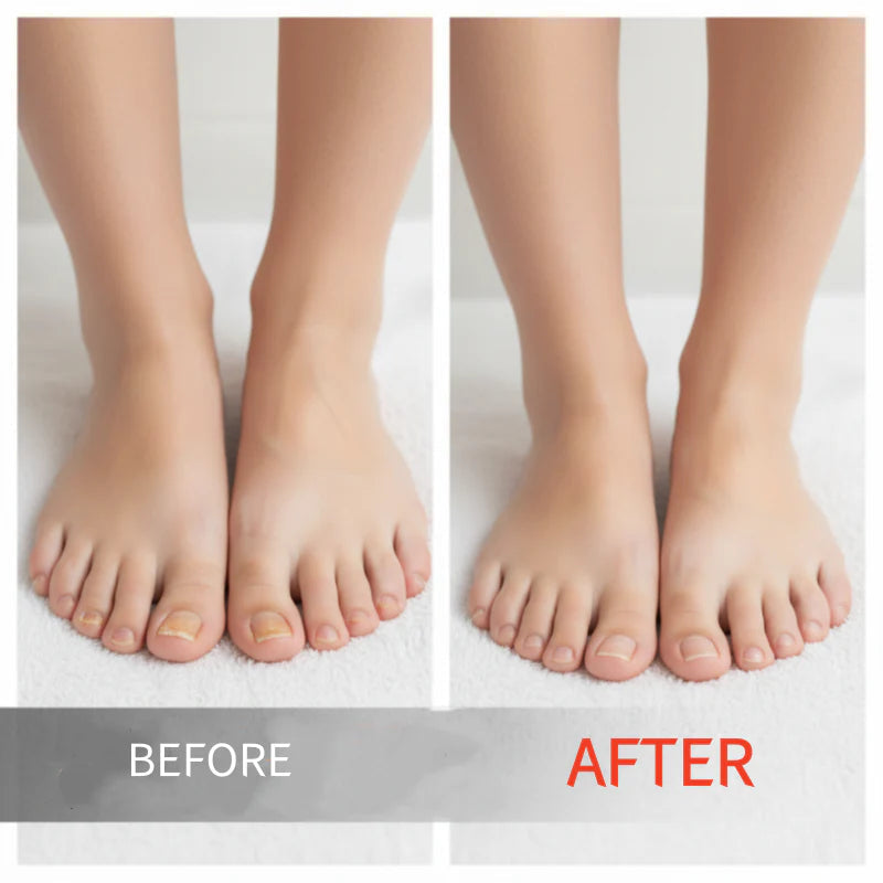 Powerful Toenail Fungus Removal Serum