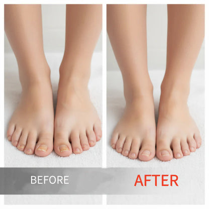 Powerful Toenail Fungus Removal Serum
