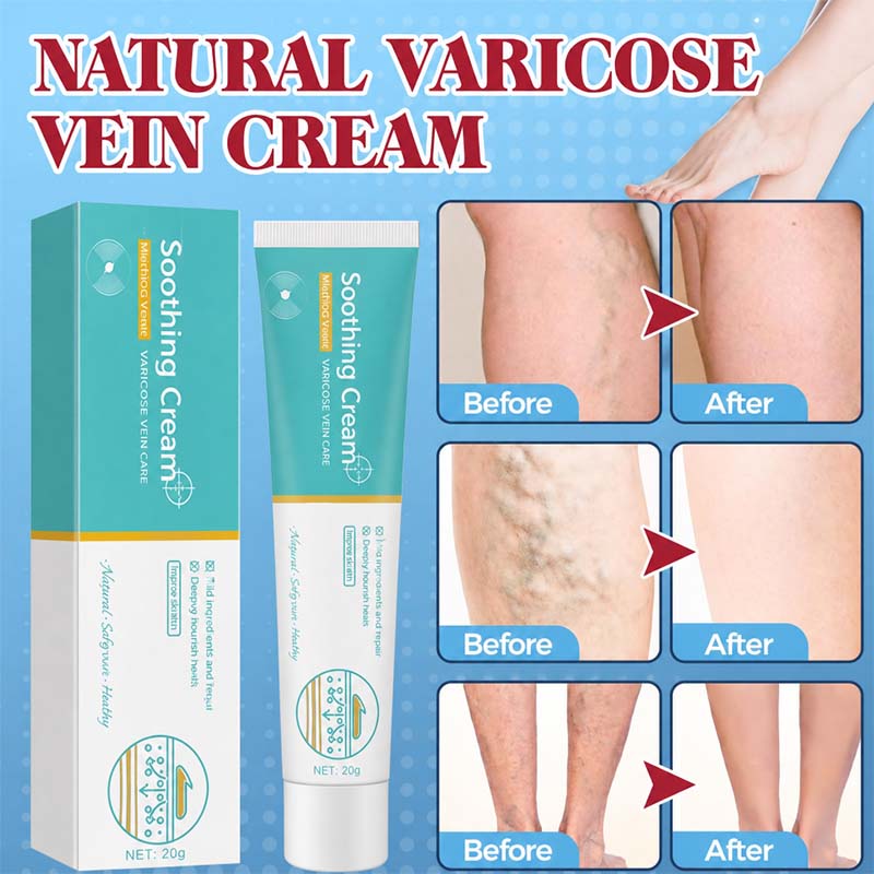 Herbal Varicose Vein Treatment Cream