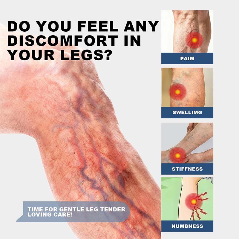 Herbal Varicose Vein Treatment Cream