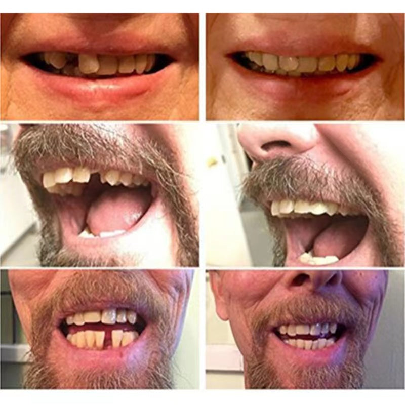 Davy | Temporary Cosmetic Dentures for a Natural Smile