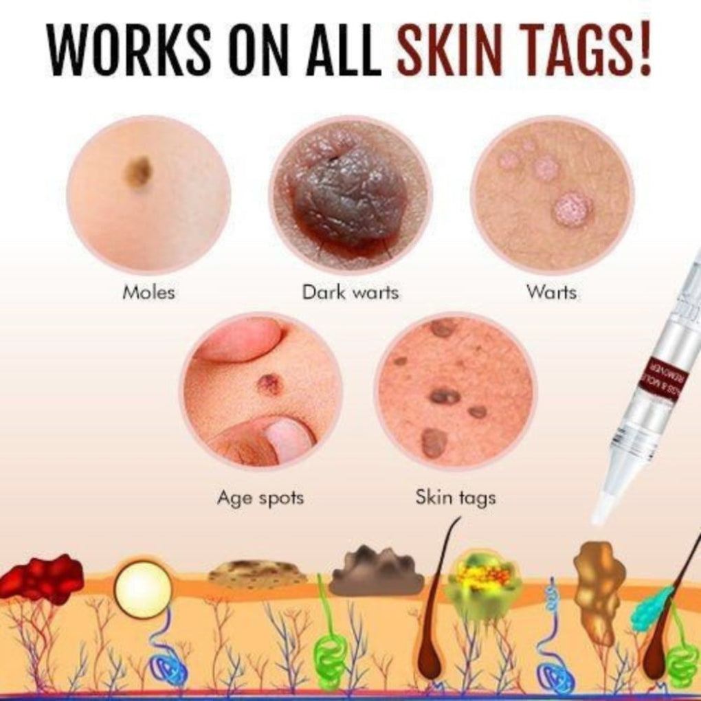 Davy | Natural Skin Tag & Mole Remover Pen