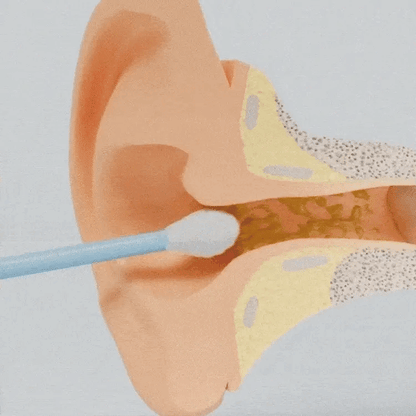 VisuClean: Advanced Ear Wax Remover with Camera