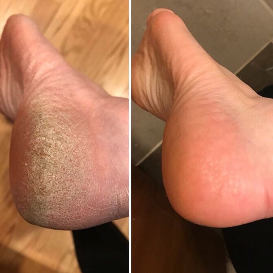 Electric Foot File for Calluses and Dry Feet
