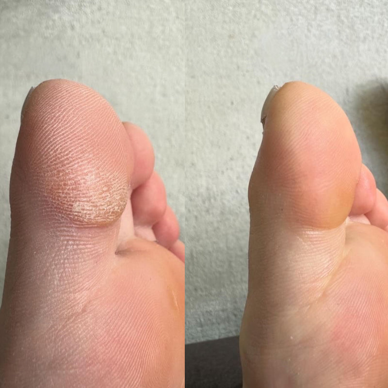 Electric Foot File for Calluses and Dry Feet