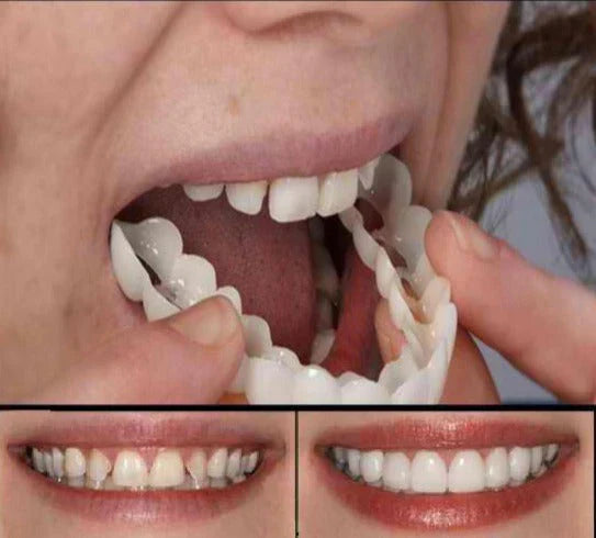 Fitflex Denture