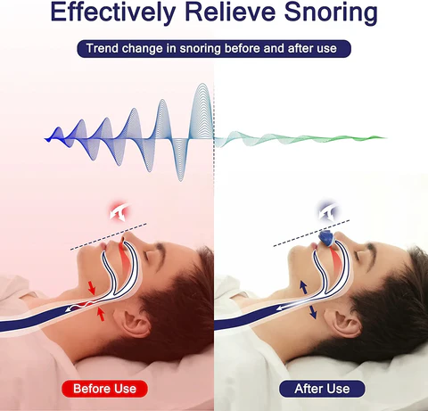 Portable Anti-Snoring Device for Sleep Apnea Relief