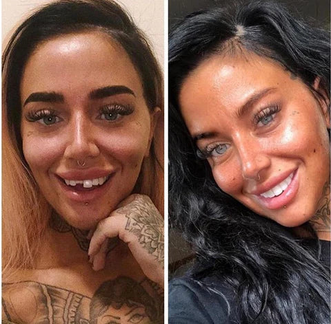 NovaBright Cosmetic Teeth Covers - Instant Smile Upgrade