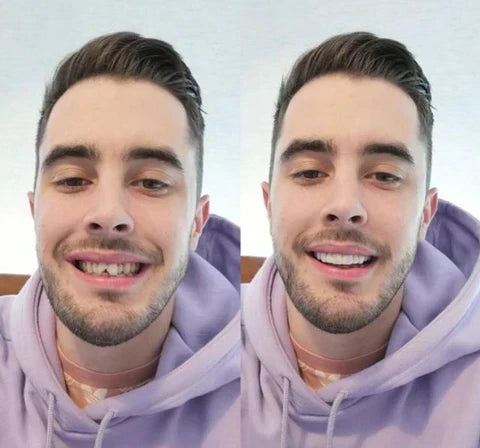 NovaBright Cosmetic Teeth Covers - Instant Smile Upgrade