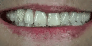 NovaBright Cosmetic Teeth Covers - Instant Smile Upgrade