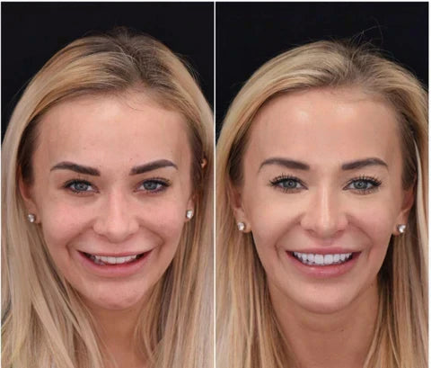 NovaBright Cosmetic Teeth Covers - Instant Smile Upgrade