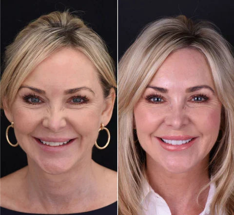 NovaBright Cosmetic Teeth Covers - Instant Smile Upgrade