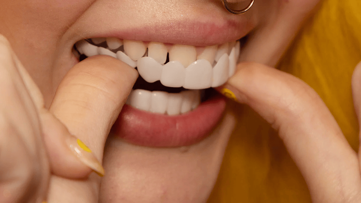 NovaBright Cosmetic Teeth Covers - Instant Smile Upgrade