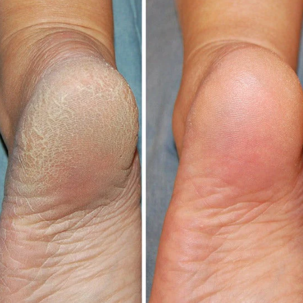Heel Repair Socks - Soften Dry, Cracked, and Tired Feet