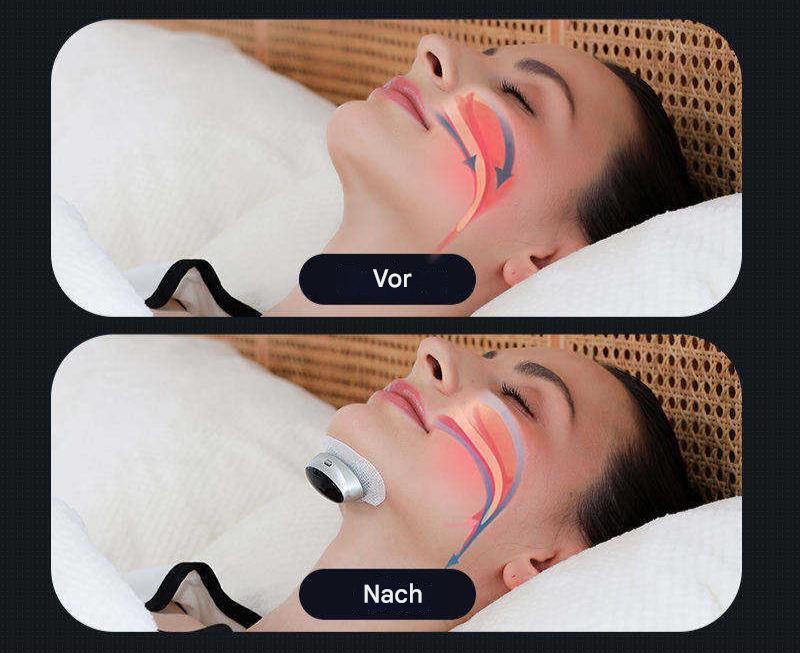 Sleep Apnea Device - AirEase